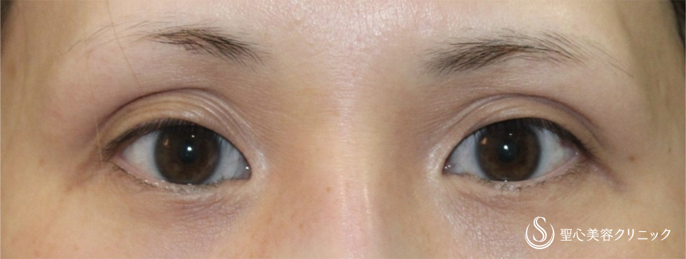 【30代女性・凹んだ瞼を改善＆綺麗な二重に】眼瞼下垂症手術（術後2ヶ月） Before 