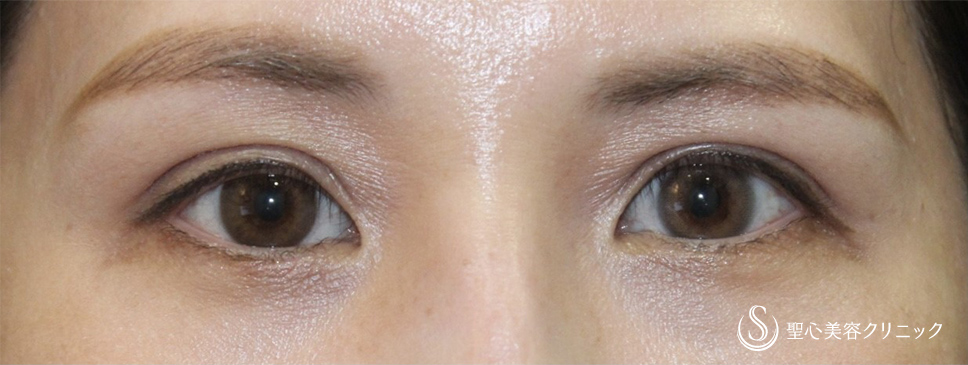 【30代女性・凹んだ瞼を改善＆綺麗な二重に】眼瞼下垂症手術（術後2ヶ月） After 