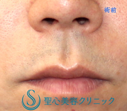【30代男性・人中を短く】鼻下短縮術（リップリフト）（術後6カ月） Before 