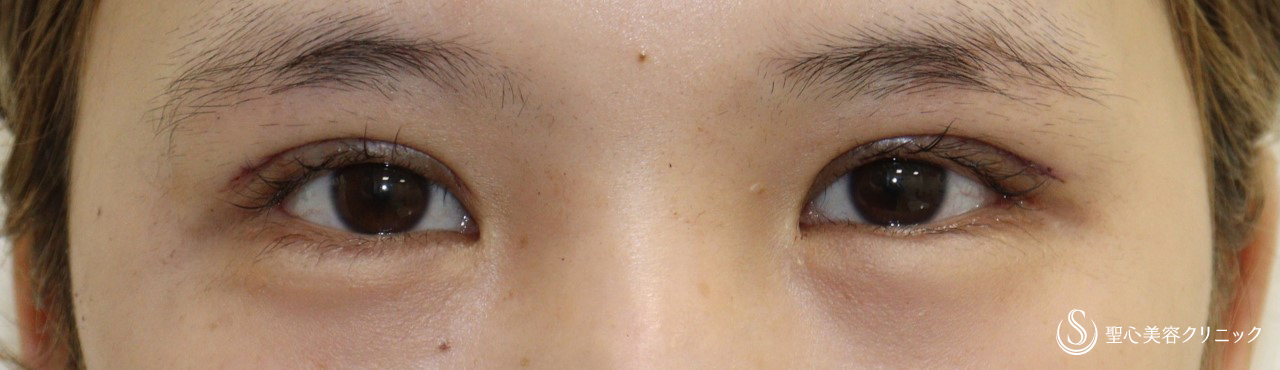 【20代女性・眼瞼下垂症手術後の目元を綺麗に】他院修正・眼瞼下垂症手術（手術直後） After 
