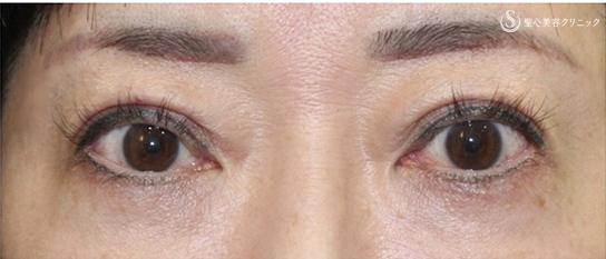 【40代女性・目周りを全体的に綺麗に】眼瞼下垂症手術＋眉下リフト＋経結膜下脱脂術（術後4ヶ月） After 