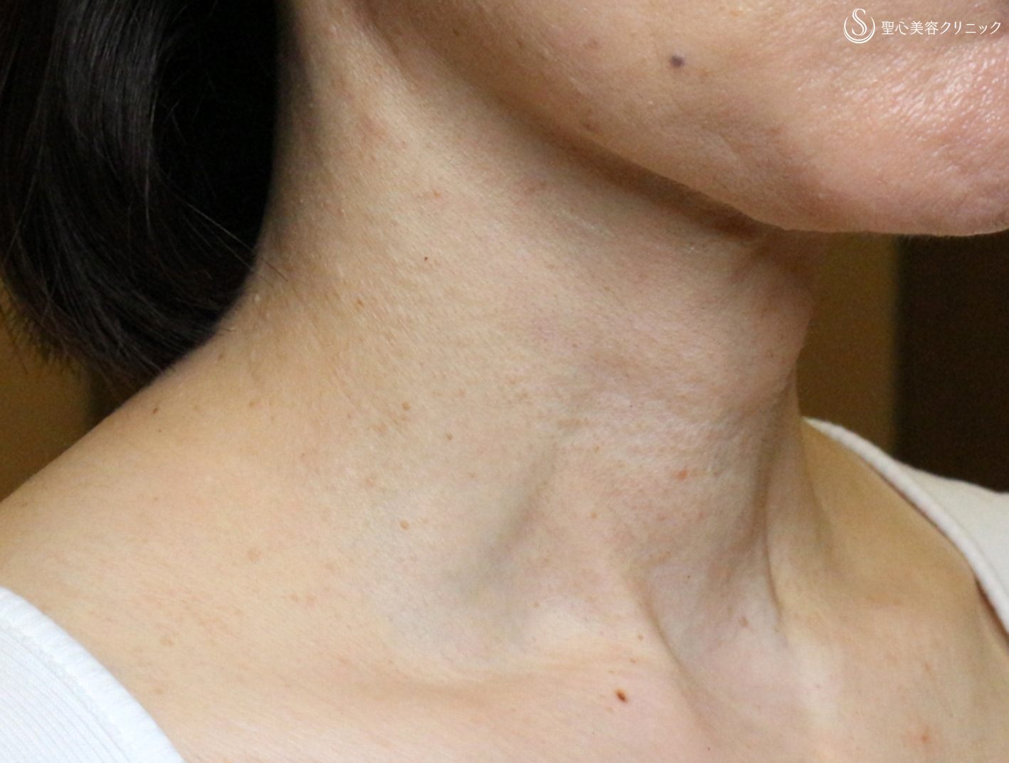 【50代女性・首の横ジワの長期経過】プレミアムPRP皮膚再生療法（10年後） After 