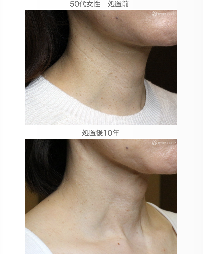 【50代女性・首の横ジワの長期経過】プレミアムPRP皮膚再生療法（10年後） After 