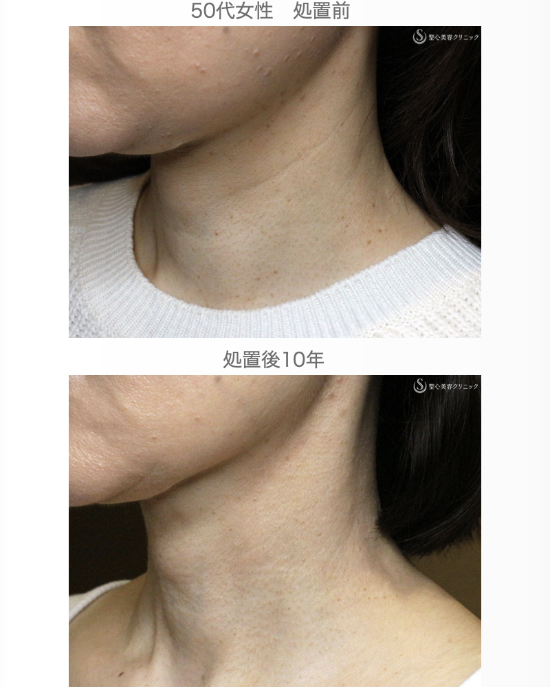 【50代女性・首の横ジワの長期経過】プレミアムPRP皮膚再生療法（10年後） After 