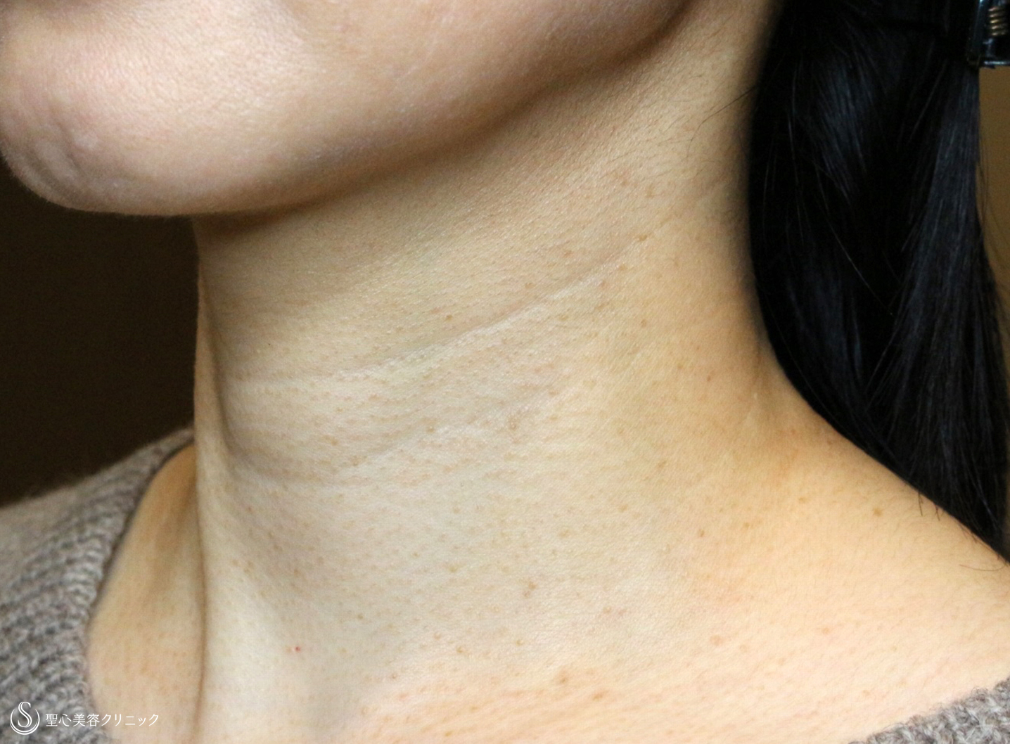 【40代女性・首の横じわを無かったことに】プレミアムPRP皮膚再生療法（6年後） Before 