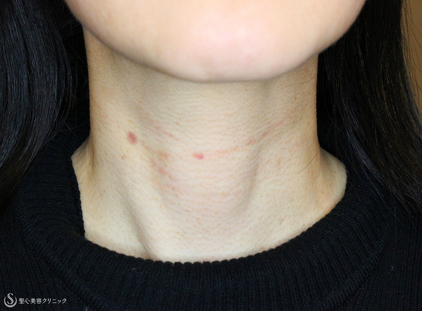 【40代女性・首の横じわを無かったことに】プレミアムPRP皮膚再生療法（6年後） After 