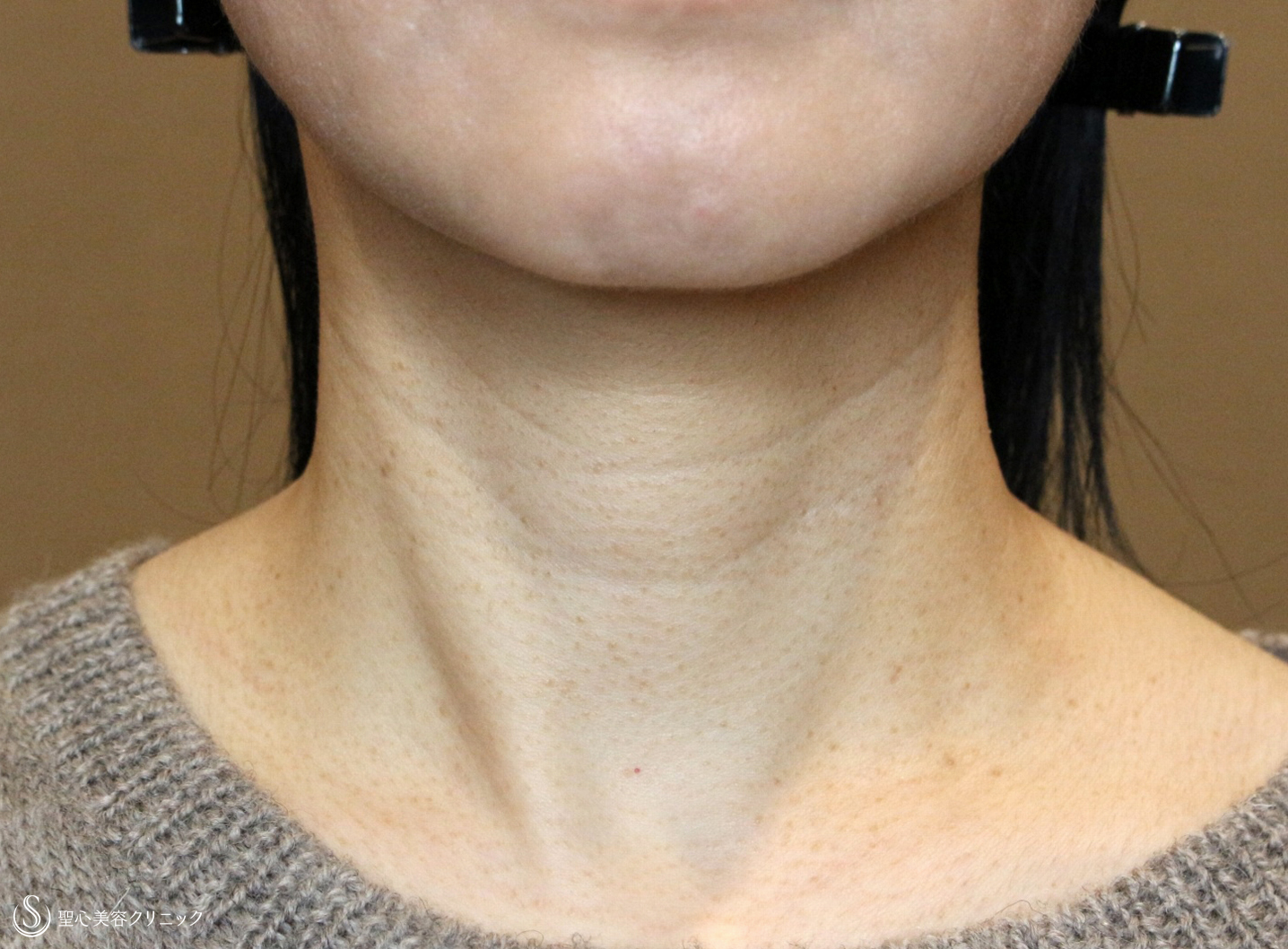 【40代女性・首の横じわを無かったことに】プレミアムPRP皮膚再生療法（5年後） Before 