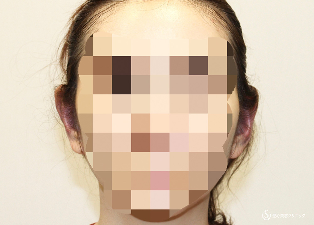 【30代女性・立ち耳】立ち耳修正（切開法）（術直後） After 