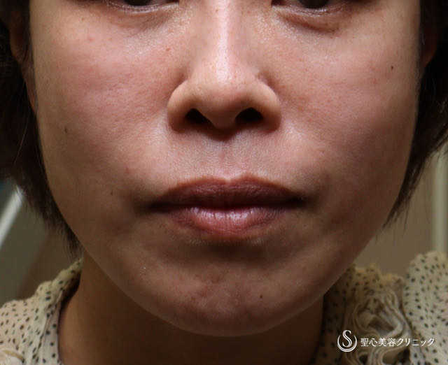 【40代女性・目の下のクマ,ほうれい線】プレミアムPRP皮膚再生療法（2年後） After 