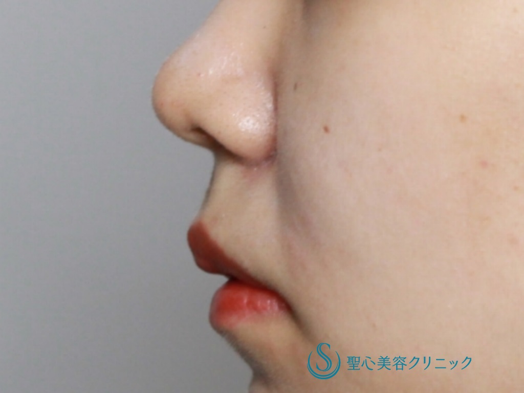 【20代女性・バランスの良い鼻に】鼻尖縮小+鼻尖形成後の鼻柱下降術（3か月後） Before 