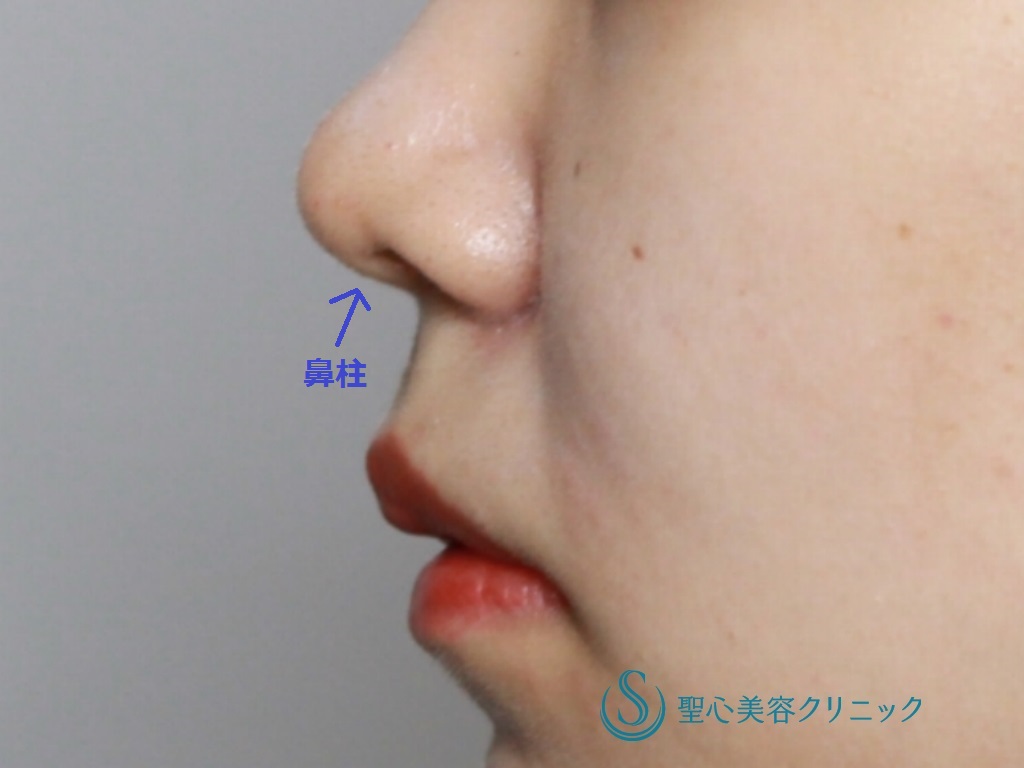 【20代女性・バランスの良い鼻に】鼻尖縮小+鼻尖形成後の鼻柱下降術（3か月後） Before 