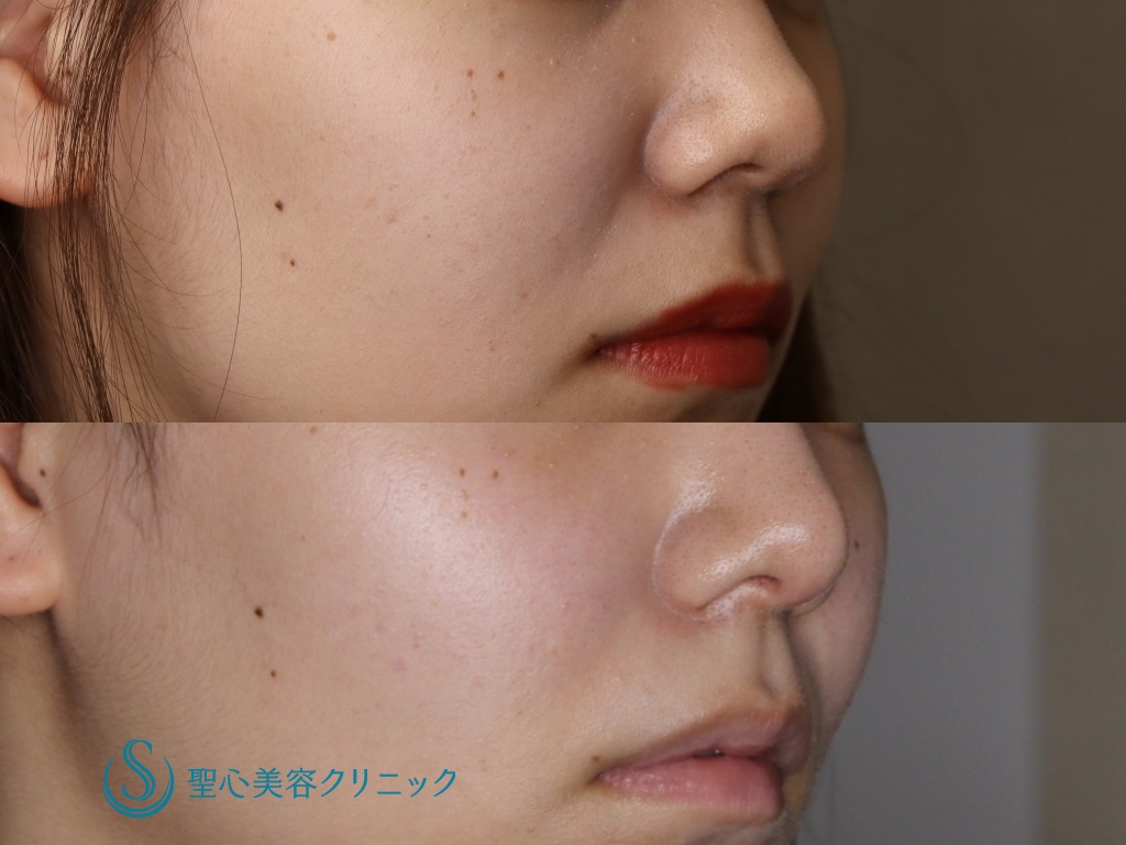 【20代女性・バランスの良い鼻に】鼻尖縮小+鼻尖形成後の鼻柱下降術（3か月後） After 