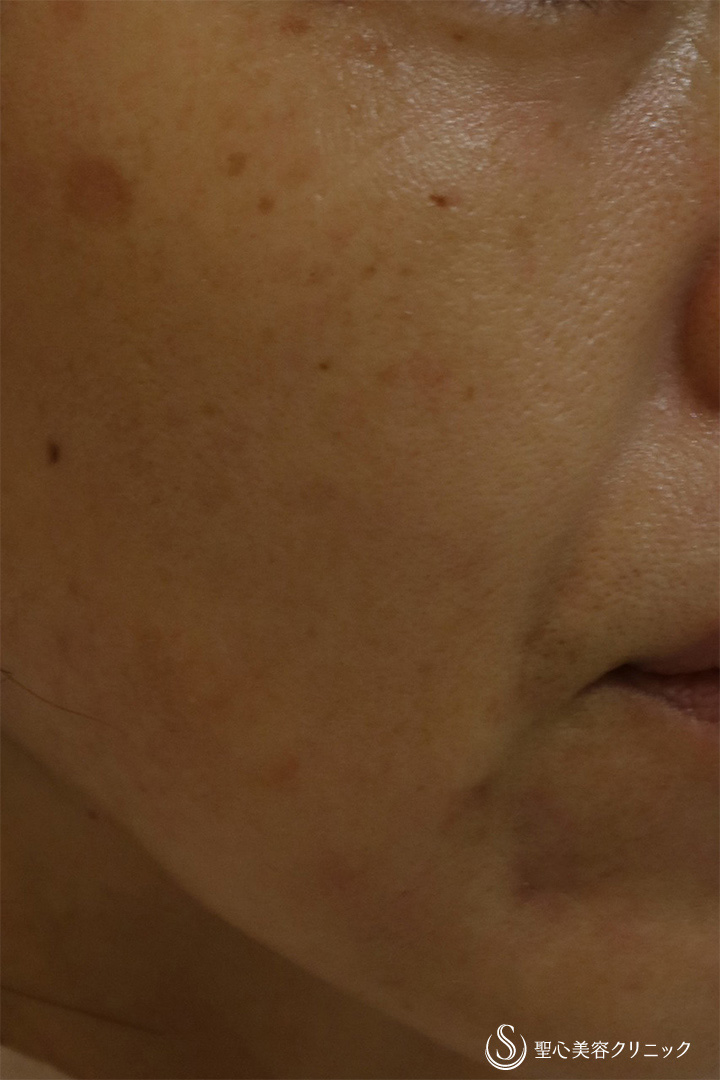 【50代女性・目の下、ほうれい線】プレミアムPRP皮膚再生療法（11か月後） Before 