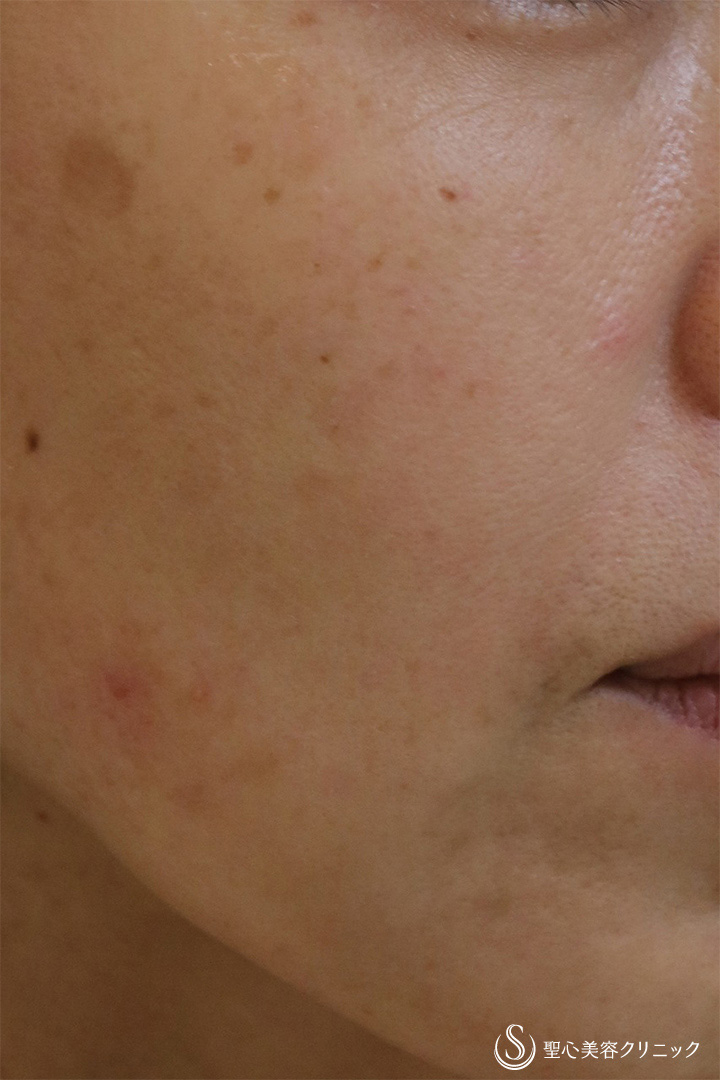 【50代女性・目の下、ほうれい線】プレミアムPRP皮膚再生療法（11か月後） After 