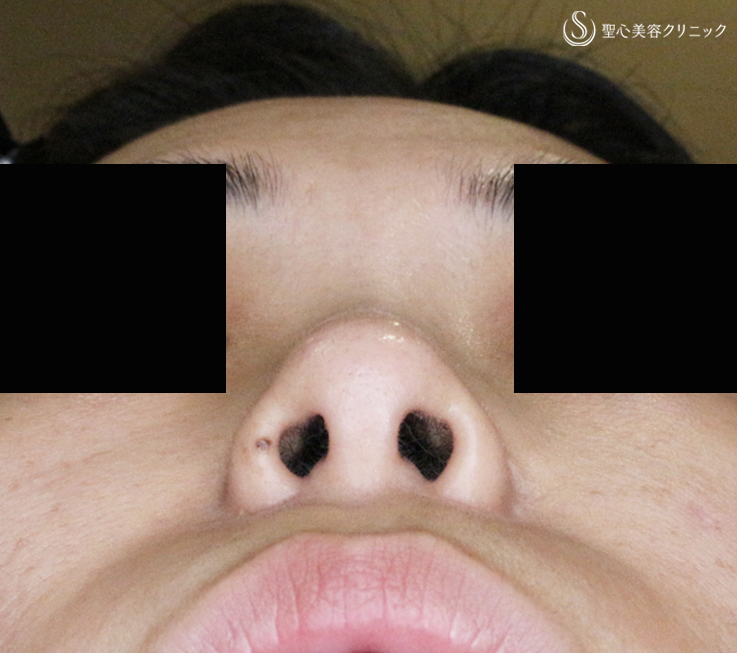 【30代女性・特徴的な鼻の印象を消す】小鼻縮小術+α法「Ver.4」＆Gメッシュ（4年4ヶ月後） After 