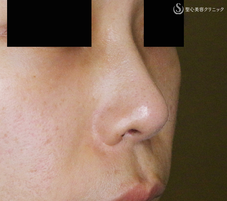 【30代女性・特徴的な鼻の印象を消す】小鼻縮小術+α法「Ver.4」＆Gメッシュ（4年4ヶ月後） After 