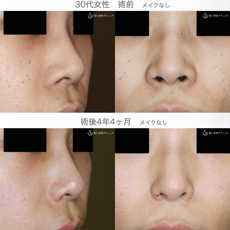 【30代女性・特徴的な鼻の印象を消す】小鼻縮小術+α法「Ver.4」＆Gメッシュ（4年4ヶ月後） After 