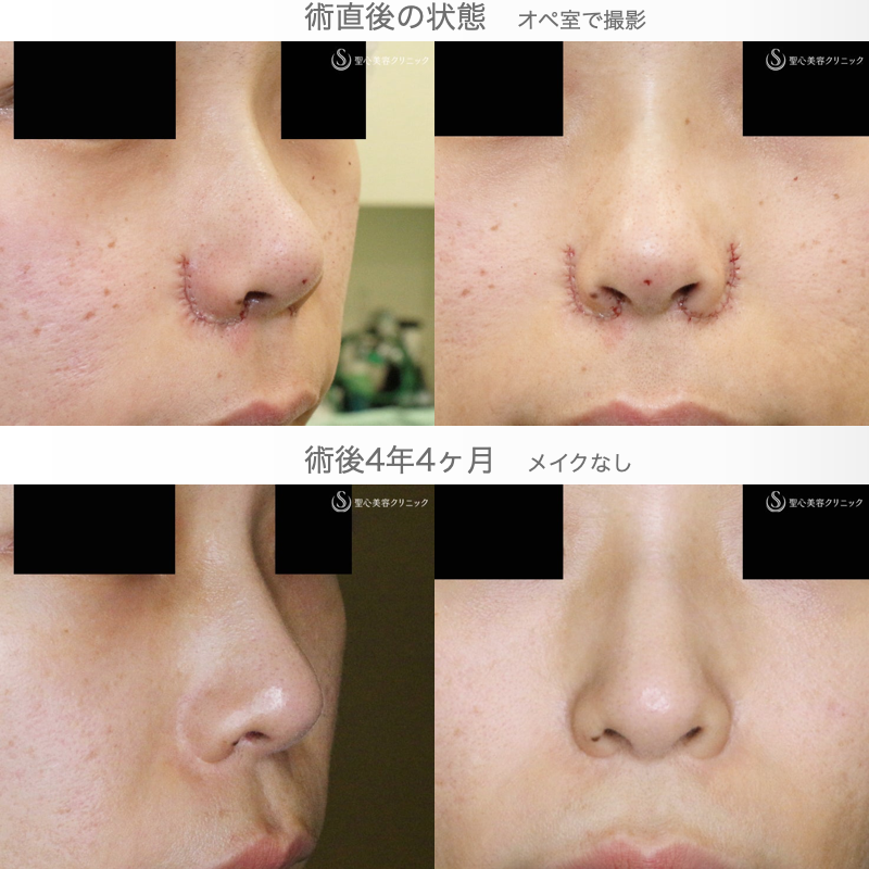 【30代女性・特徴的な鼻の印象を消す】小鼻縮小術+α法「Ver.4」＆Gメッシュ（4年4ヶ月後） After 