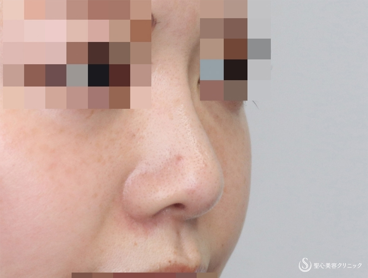 【20代女性・鼻筋と鼻先を美しく】Gメッシュ＋鼻先縮小＋耳介軟骨移植（3ヶ月後） After 