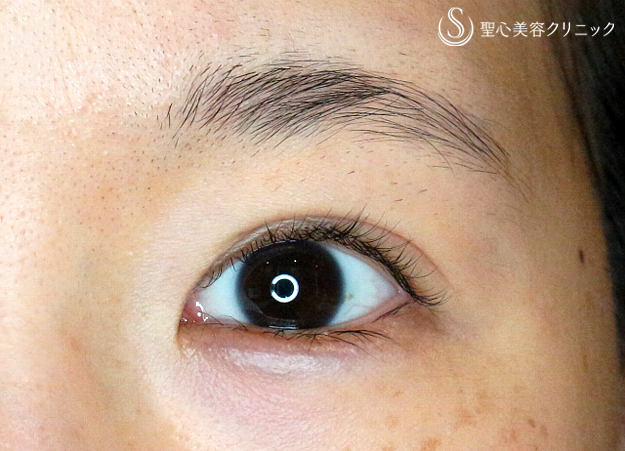 【20代女性・他院修正で自然な末広型二重】二重全切開+α法「Ver.4」（4年後） After 