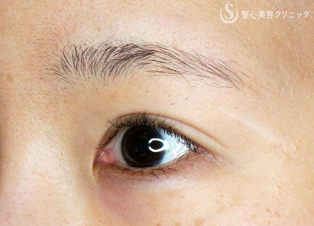 【20代女性・他院修正で自然な末広型二重】二重全切開+α法「Ver.4」（4年後） After 