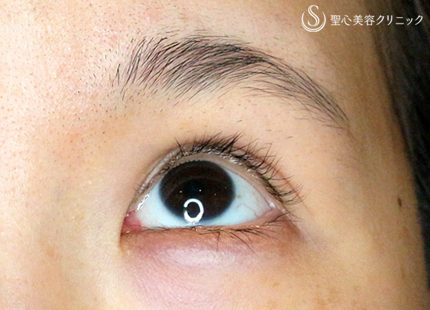 【20代女性・他院修正で自然な末広型二重】二重全切開+α法「Ver.4」（4年後） After 