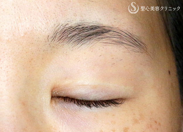 【20代女性・他院修正で自然な末広型二重】二重全切開+α法「Ver.4」（4年後） After 