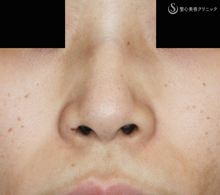 【30代女性・特徴的な鼻の印象を消す】小鼻縮小術+α法＆Gメッシュ（1年2ヶ月後） Before 