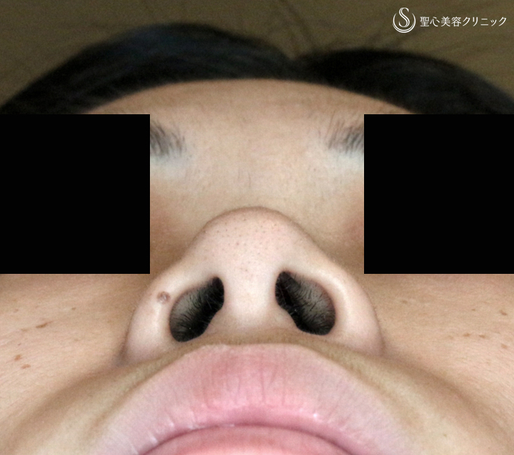【30代女性・特徴的な鼻の印象を消す】小鼻縮小術+α法「Ver.4」＆Gメッシュ（4年4ヶ月後） Before 