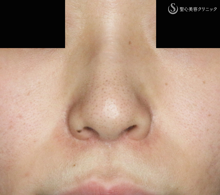【30代女性・特徴的な鼻の印象を消す】小鼻縮小術+α法＆Gメッシュ（1年2ヶ月後） After 