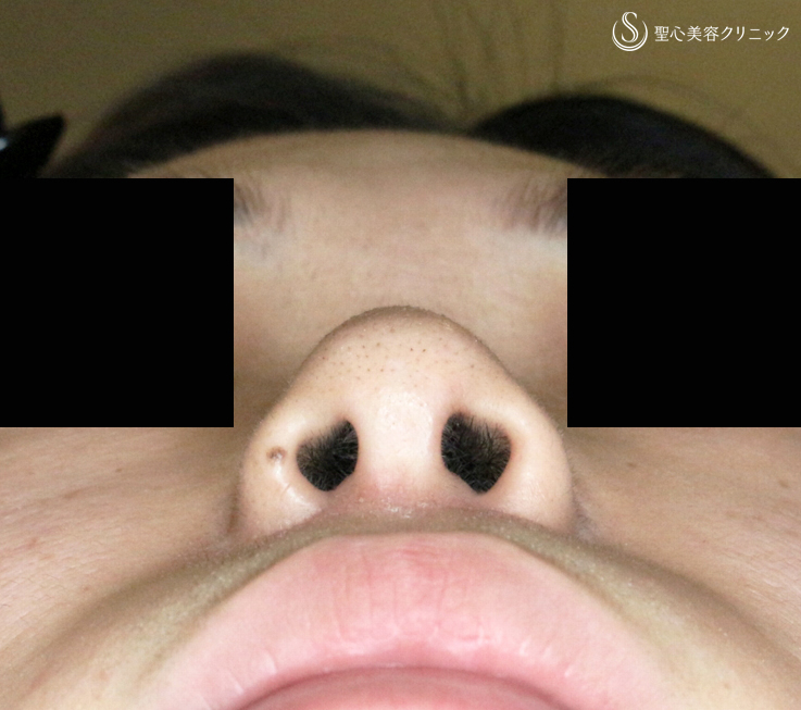 【30代女性・特徴的な鼻の印象を消す】小鼻縮小術+α法＆Gメッシュ（1年2ヶ月後） After 