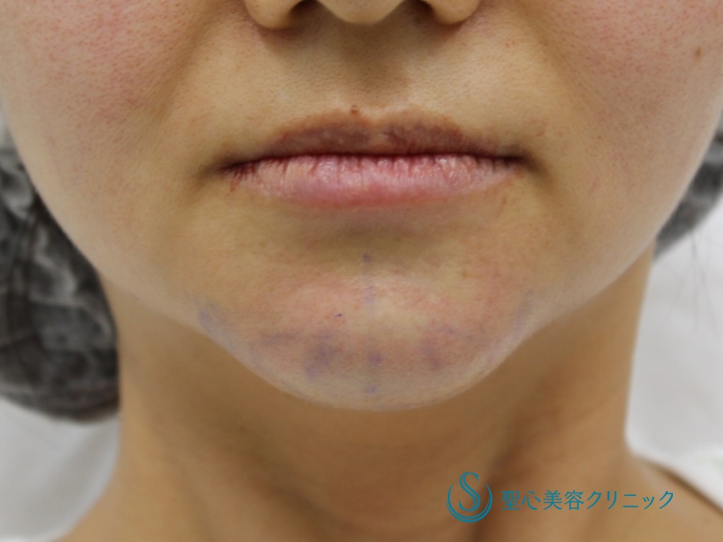 【30代女性・綺麗な顎にしたい】顎のプロテーゼ（術後1ヶ月） Before 