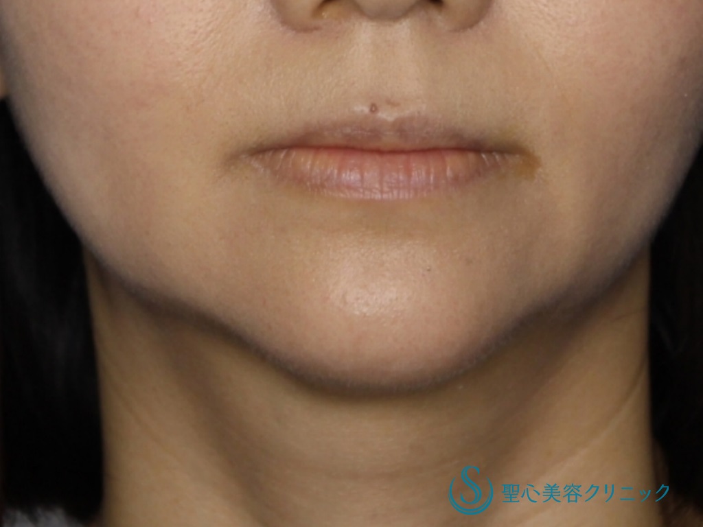 【30代女性・綺麗な顎にしたい】顎のプロテーゼ（術後1ヶ月） After 