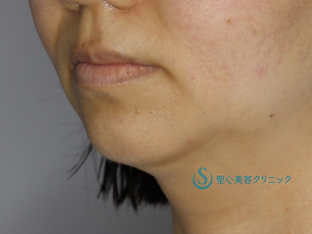 【30代女性・綺麗な顎にしたい】顎のプロテーゼ（術後1ヶ月） Before 