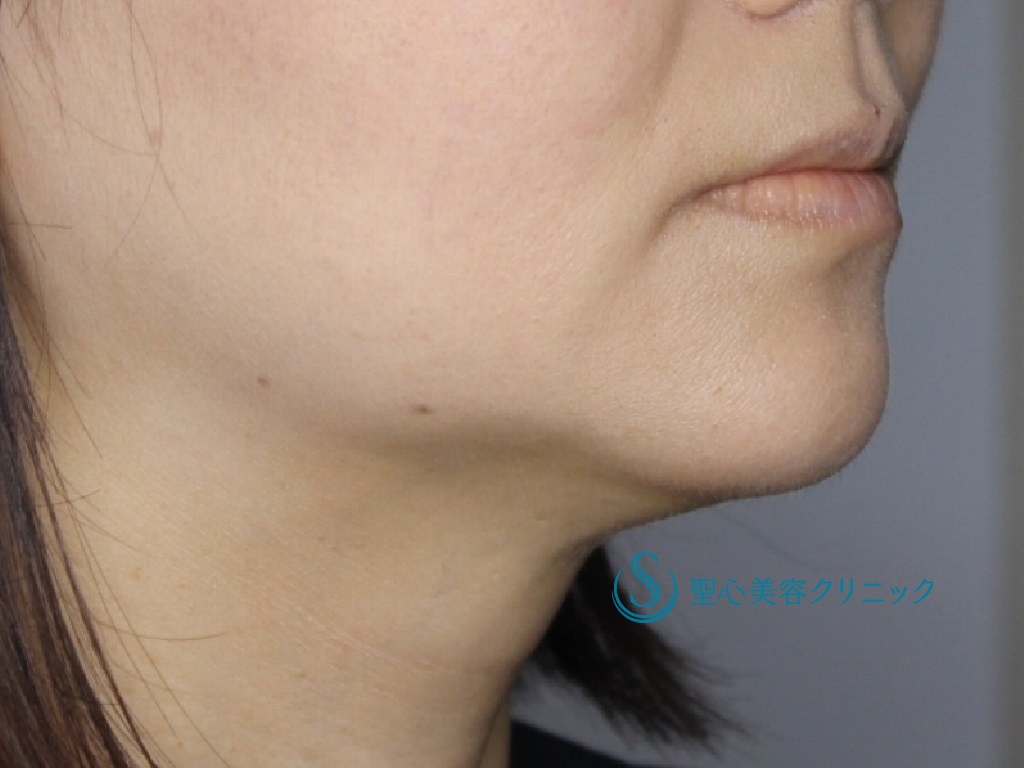 【30代女性・綺麗な顎にしたい】顎のプロテーゼ（術後1ヶ月） After 