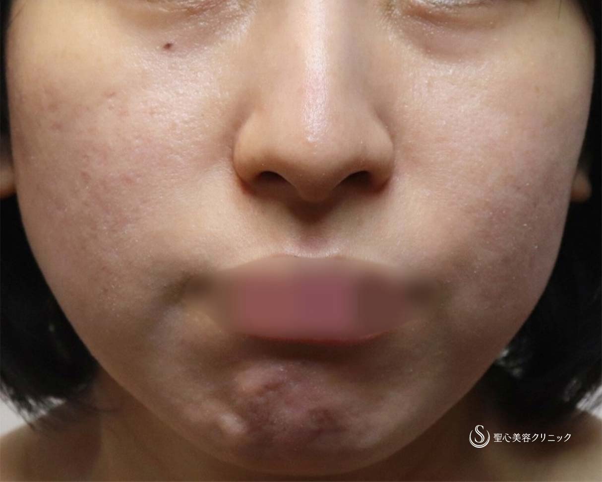 【30代女性・ナチュラルにマイナス10歳】プレミアムPRP皮膚再生療法（目の下、ほうれい線）とドクターハイフ（ウルトラセルQプラス）（術後6ヶ月、2年） Before 