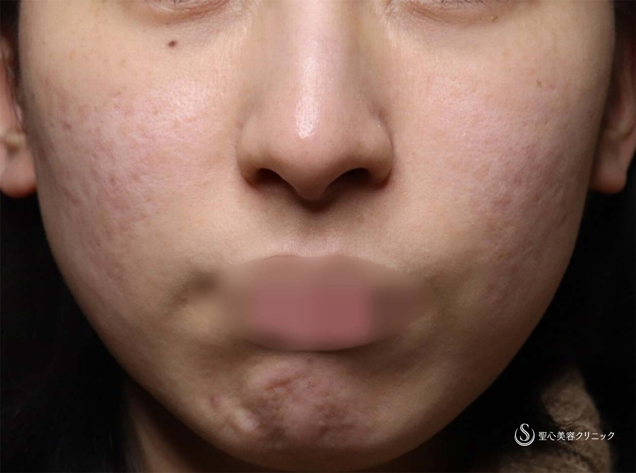 【30代女性・ナチュラルにマイナス10歳】プレミアムPRP皮膚再生療法（目の下、ほうれい線）とドクターハイフ（ウルトラセルQプラス）（術後6ヶ月、2年） After 