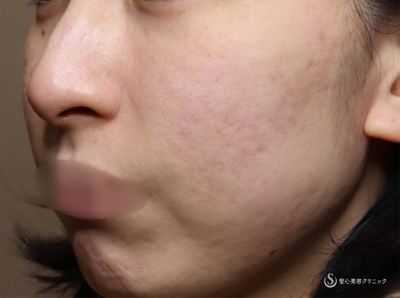 【30代女性・ナチュラルにマイナス10歳】プレミアムPRP皮膚再生療法（目の下、ほうれい線）とドクターハイフ（ウルトラセルQプラス）（術後6ヶ月、2年） After 