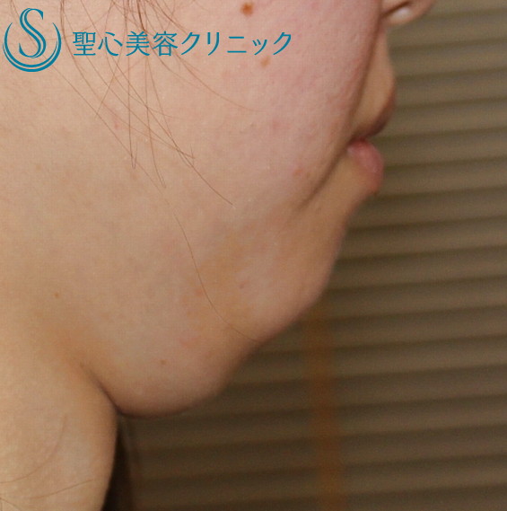 【20代女性・二重あごをすっきりと】FatX脂肪溶解注射（2回注射後2カ月後） Before 