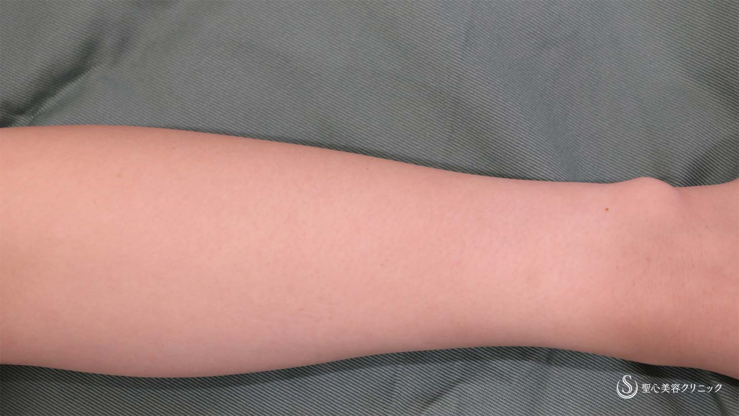 【20代女性・前腕の刺青】刺青・タトゥー除去（治療4回後） After 