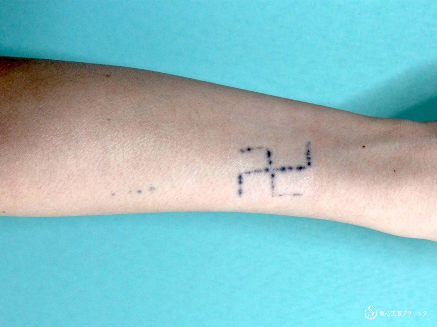 【20代女性・前腕の刺青】刺青・タトゥー除去（治療4回後） Before 
