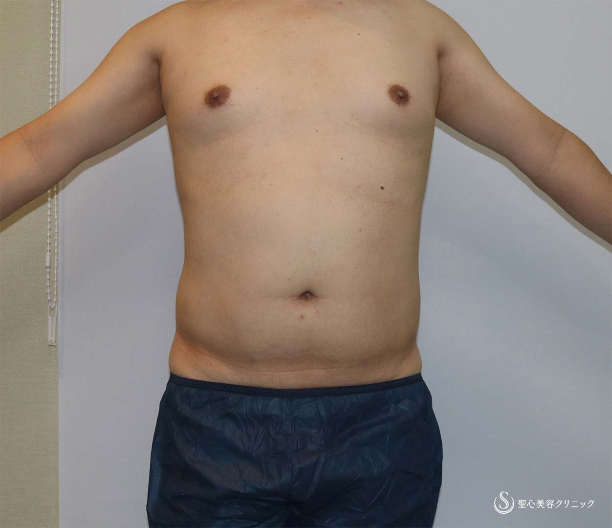 【40代男性・脂肪吸引】ベイザーリポ2.2脂肪吸引　腹部全体＋腰（術後4カ月） Before 