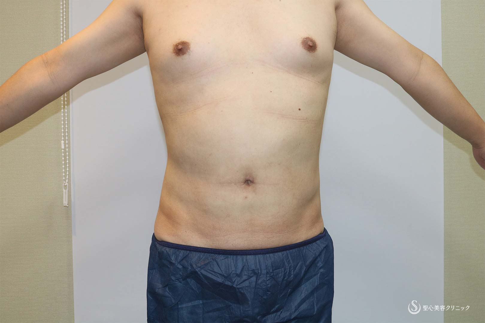 【40代男性・脂肪吸引】ベイザーリポ2.2脂肪吸引　腹部全体＋腰（術後4カ月） After 