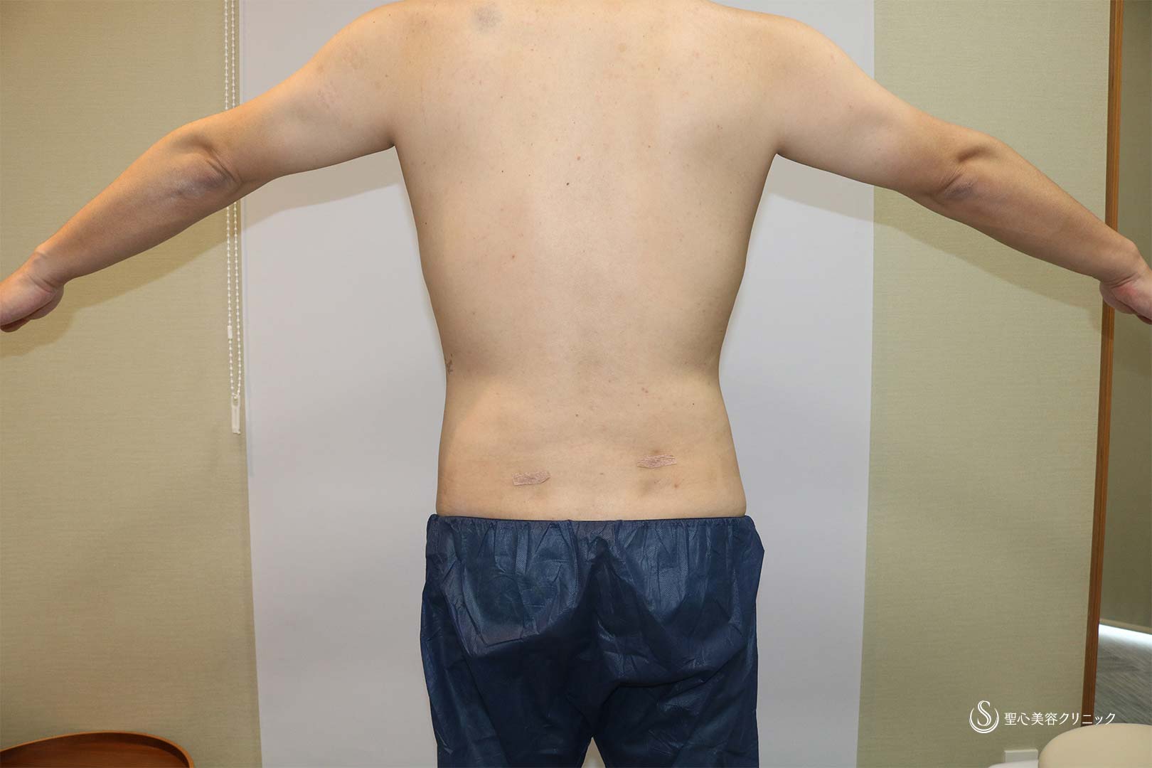 【40代男性・脂肪吸引】ベイザーリポ2.2脂肪吸引　腹部全体＋腰（術後4カ月） After 