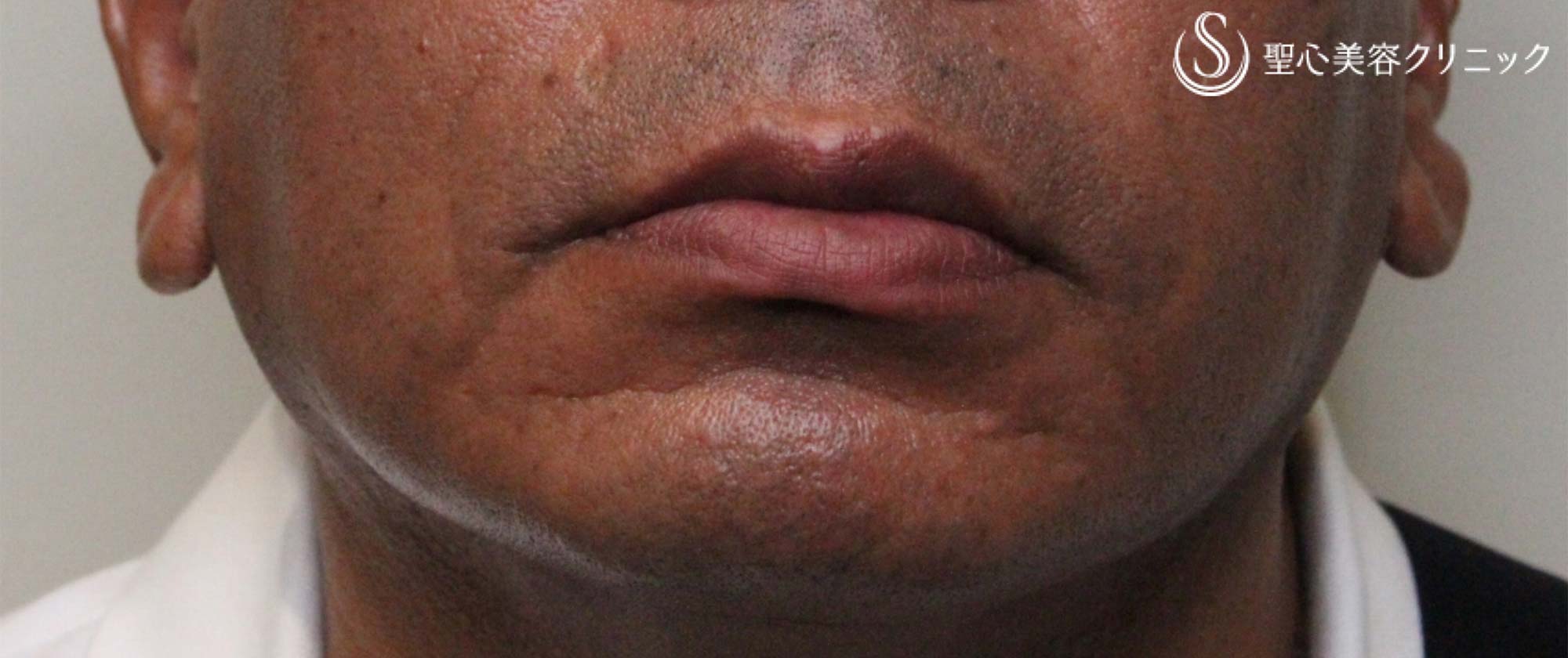 【40代男性・顎の深いしわ】プレミアムPRP皮膚再生療法（2年後） Before 