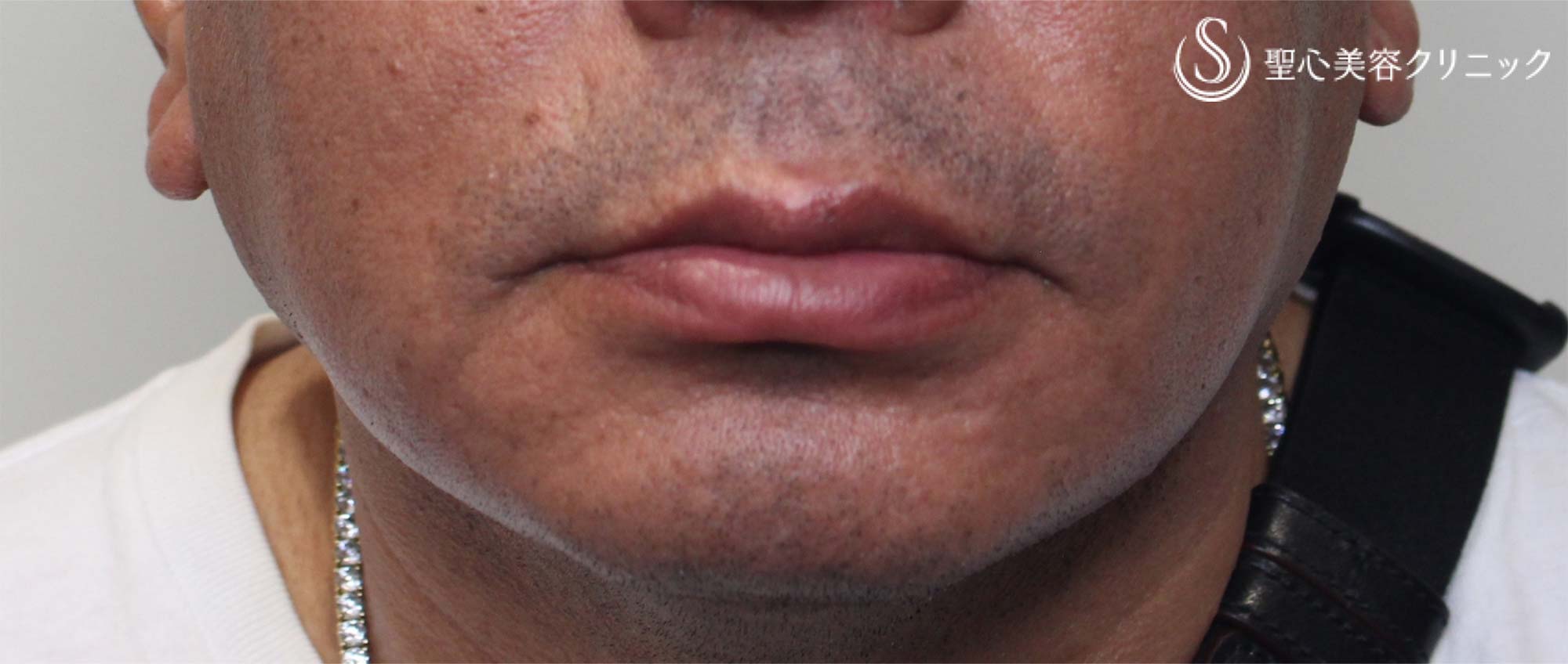 【40代男性・顎の深いしわ】プレミアムPRP皮膚再生療法（2年後） After 