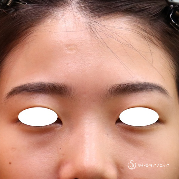 【20代女性・目の下のくまと額のくぼみ】プレミアムPRP皮膚再生療法 目の下、額（6ヶ月後） Before 
