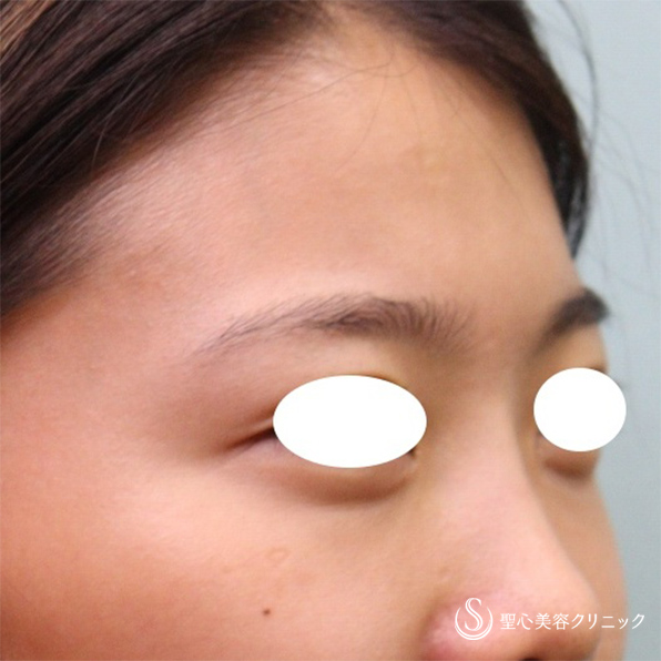 【20代女性・目の下のくまと額のくぼみ】プレミアムPRP皮膚再生療法 目の下、額（6ヶ月後） After 