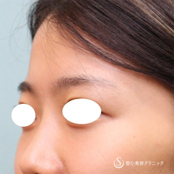 【20代女性・目の下のくまと額のくぼみ】プレミアムPRP皮膚再生療法 目の下、額（6ヶ月後） After 