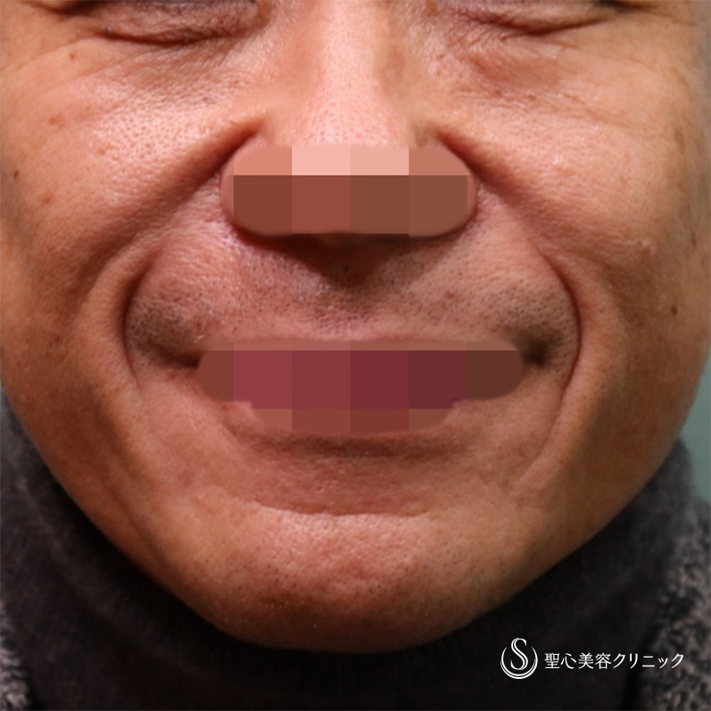 【50代男性・目の下とほうれい線】プレミアムPRP皮膚再生療法（6ヶ月後） Before 